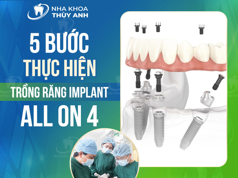 5 bước thực hiện trồng răng implant all on 4 tại nha khoa Thùy Anh