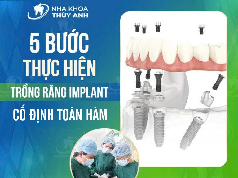 5 bước thực hiện trồng răng implant cố định toàn hàm