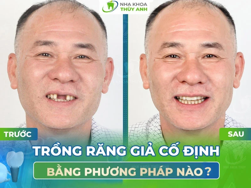 Trồng răng giả cố định bằng phương pháp nào?