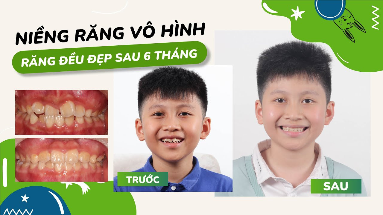 Invisalign first: Niềng răng bằng khay trong suốt cho trẻ có hiệu quả không?
