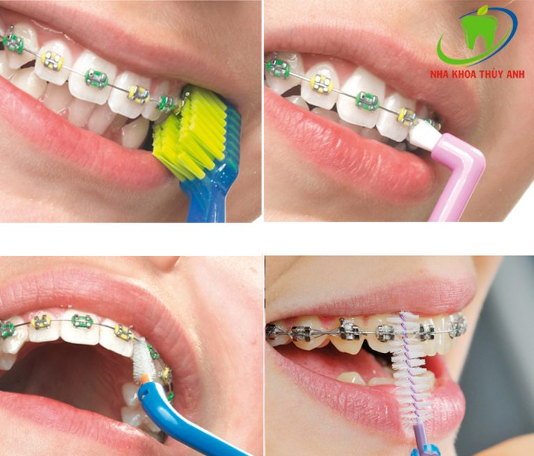 Chế độ ăn và vệ sinh răng miệng khi niềng răng
