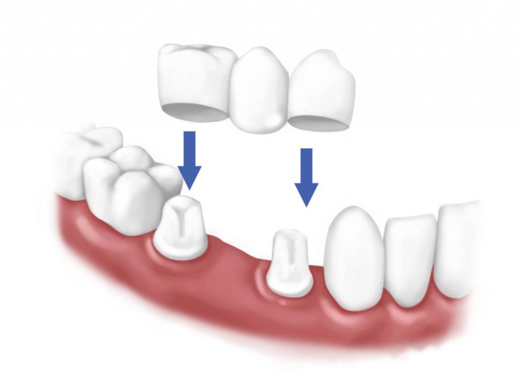 Viêm lợi sau khi bọc răng sứ – nguyên nhân và cách khắc phục