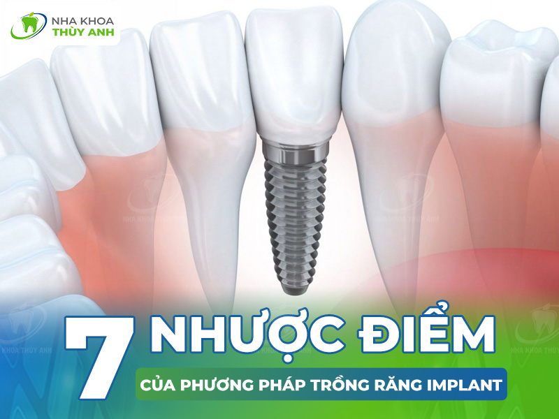 7 nhược điểm của trồng răng implant và 4 ưu điểm của implant