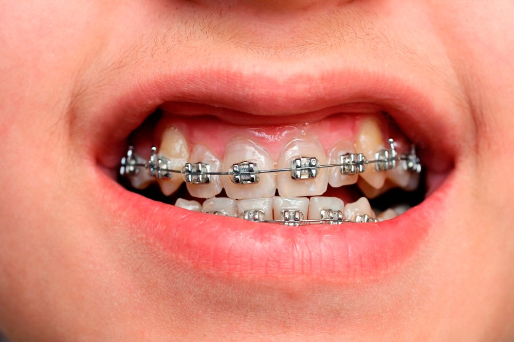 Hỏi đáp: Tại sao niềng răng bị cười hở lợi nặng hơn?
