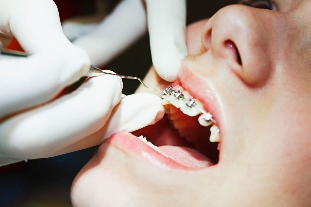 Lợi ích và quy trình niềng răng tại địa chỉ niềng răng Thái Nguyên Thùy Anh