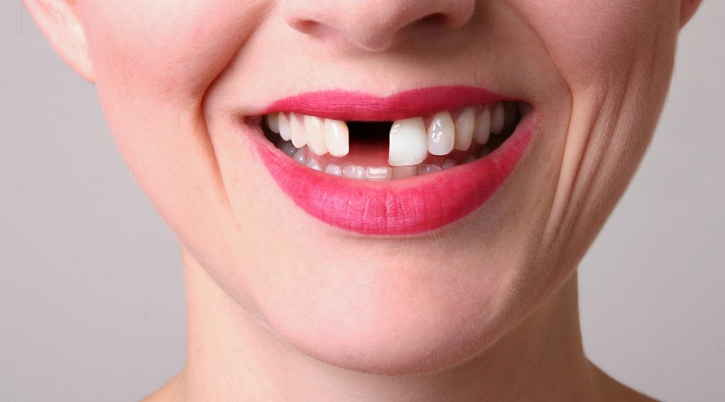 Trồng răng giả Thái Nguyên và 3 phương pháp được ưa chuộng nhất hiện nay