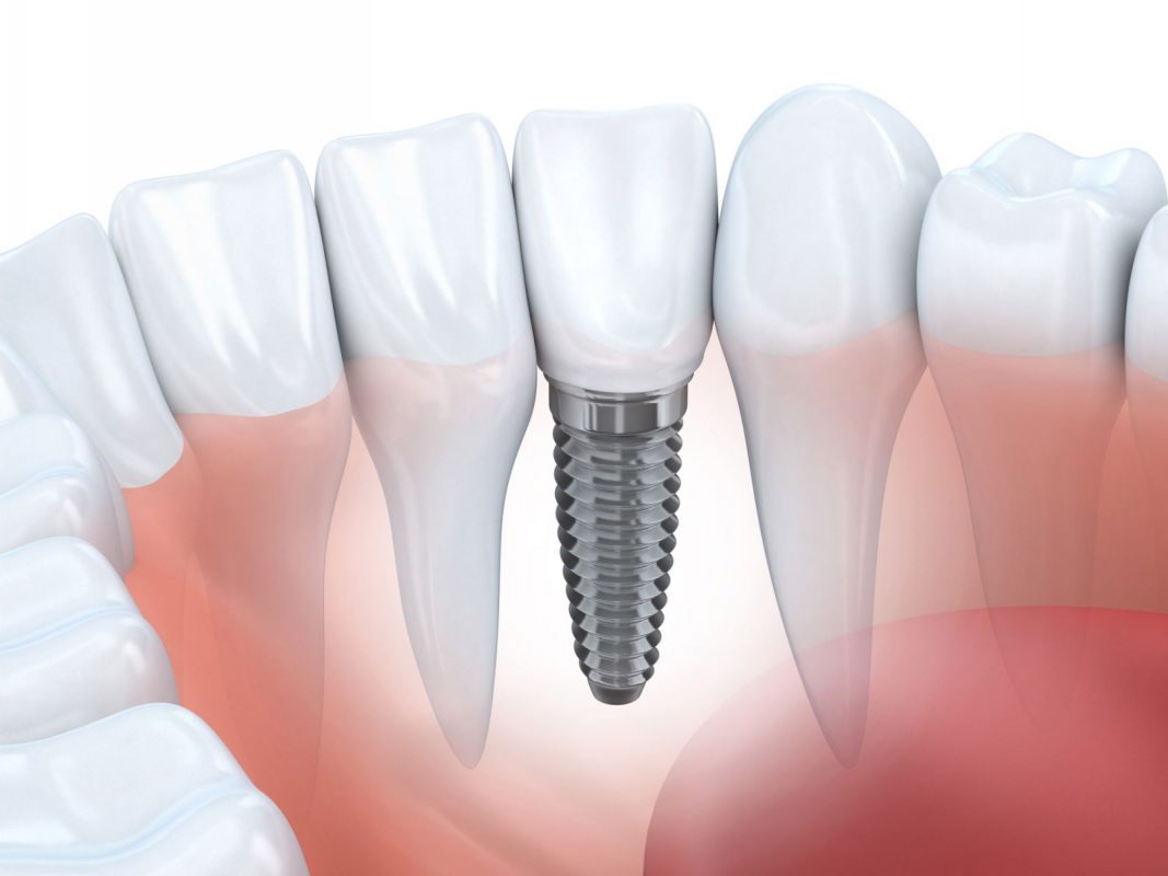 7 nhược điểm của phương pháp trồng răng implant bạn cần nắm rõ - nhakhoathuyanh