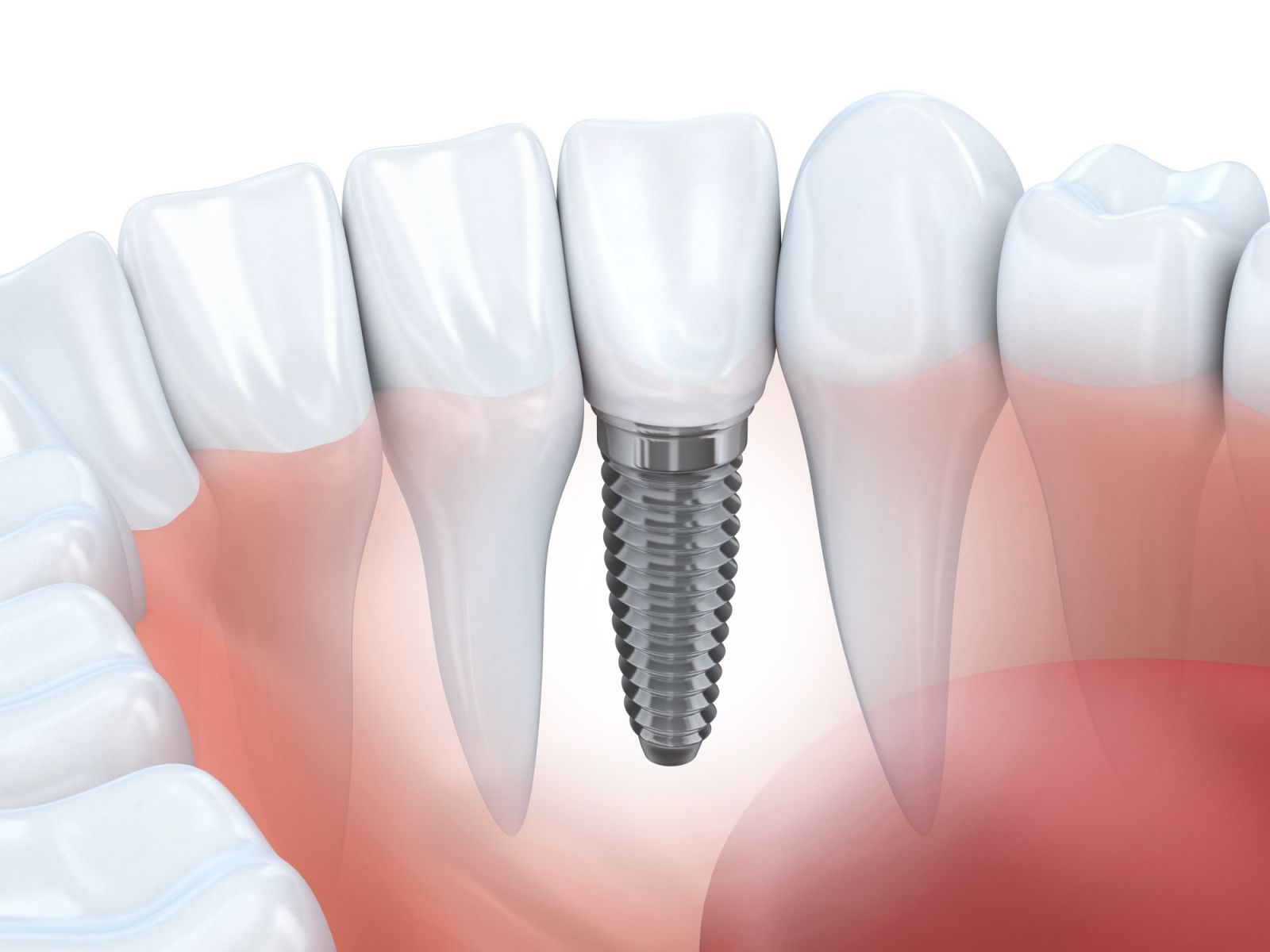 Nhược điểm của việc trồng răng implant?

