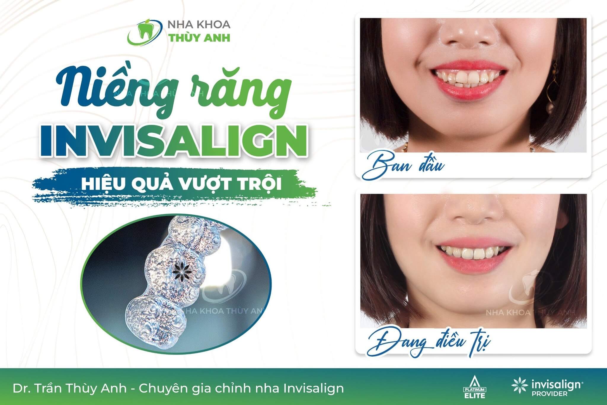 Phương pháp niềng răng invisalign và bí quyết để đạt hiệu quả tốt nhất