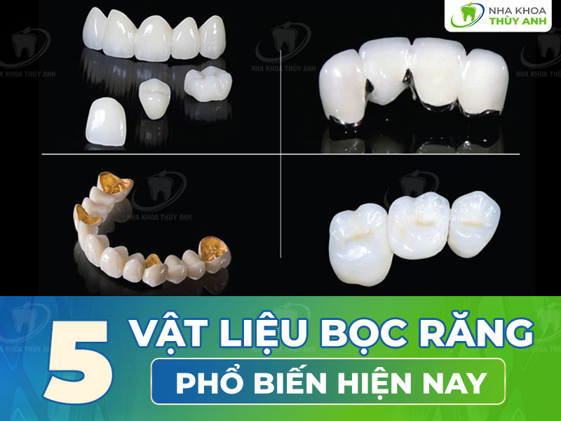 5 vật liệu bọc răng phổ biến hiện nay nên chọn loại nào phù hợp?