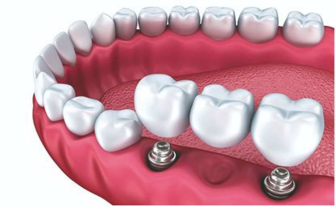 cay-ghep-implant-sau-nho-rang-bao-lau-3