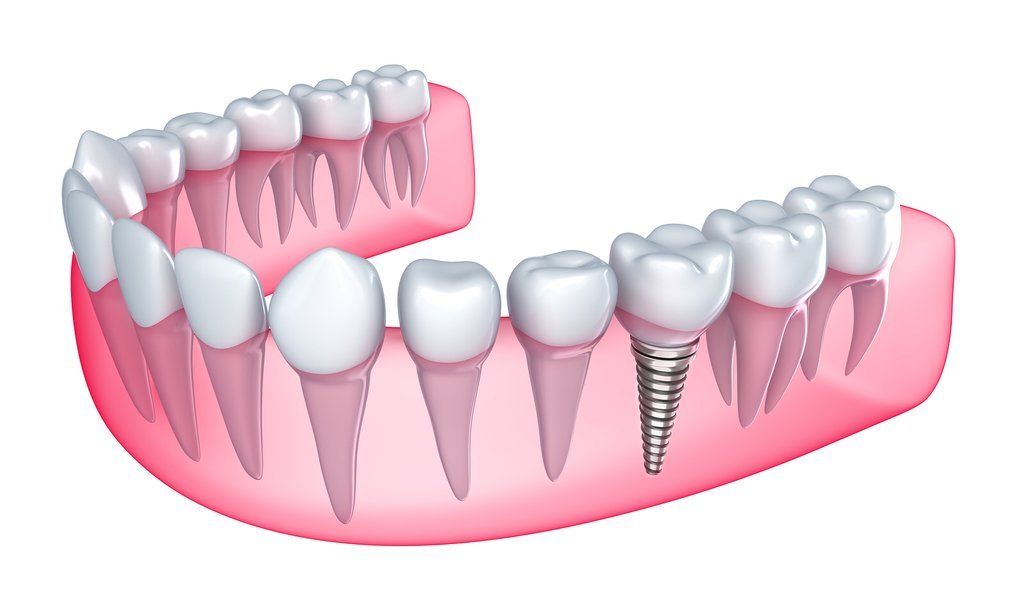 Thời gian sau nhổ răng bao lâu thì có thể cấy implant