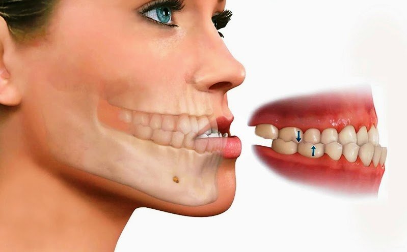 Niềng răng móm có ảnh hưởng đến việc ăn uống, nói chuyện và chăm sóc răng miệng không?
