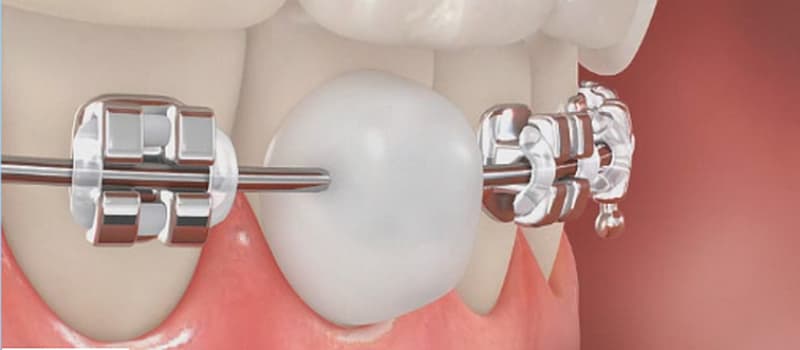 Đặc điểm và cách sử dụng sáp niềng răng để giảm đau và khó chịu