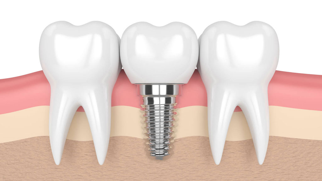 Chuyên gia hướng dẫn cách để răng implant tồn tại suốt đời? - nhakhoathuyanh