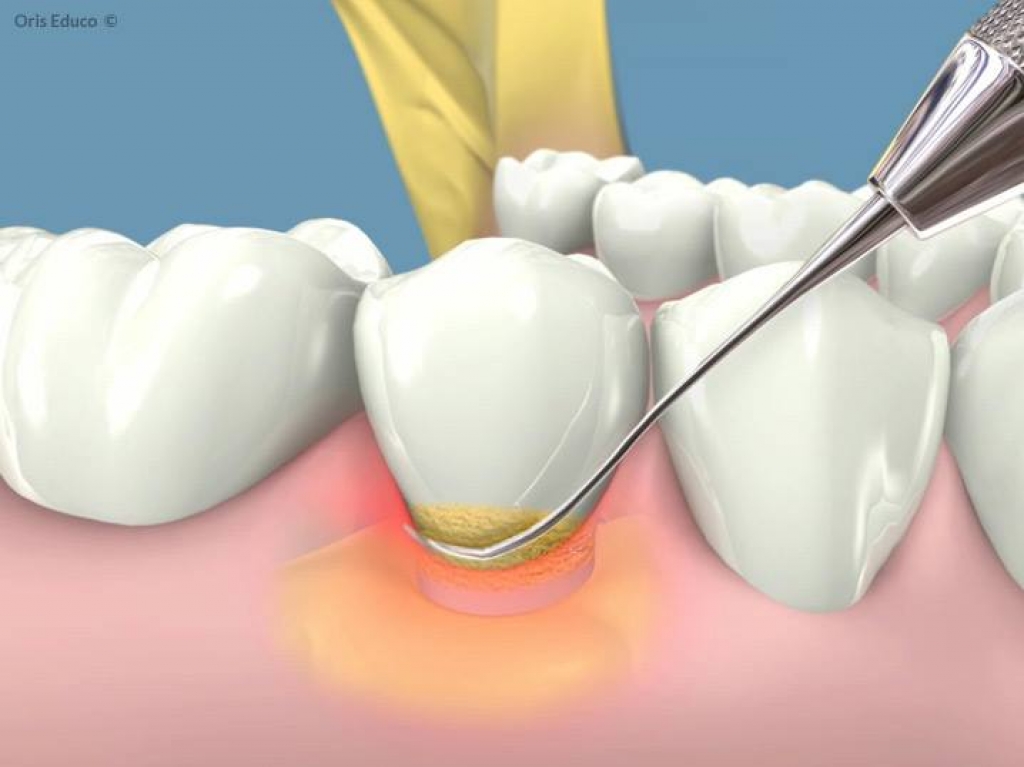 12 bước thực hiện hàn cổ răng điều trị ê buốt chân răng hiệu quả