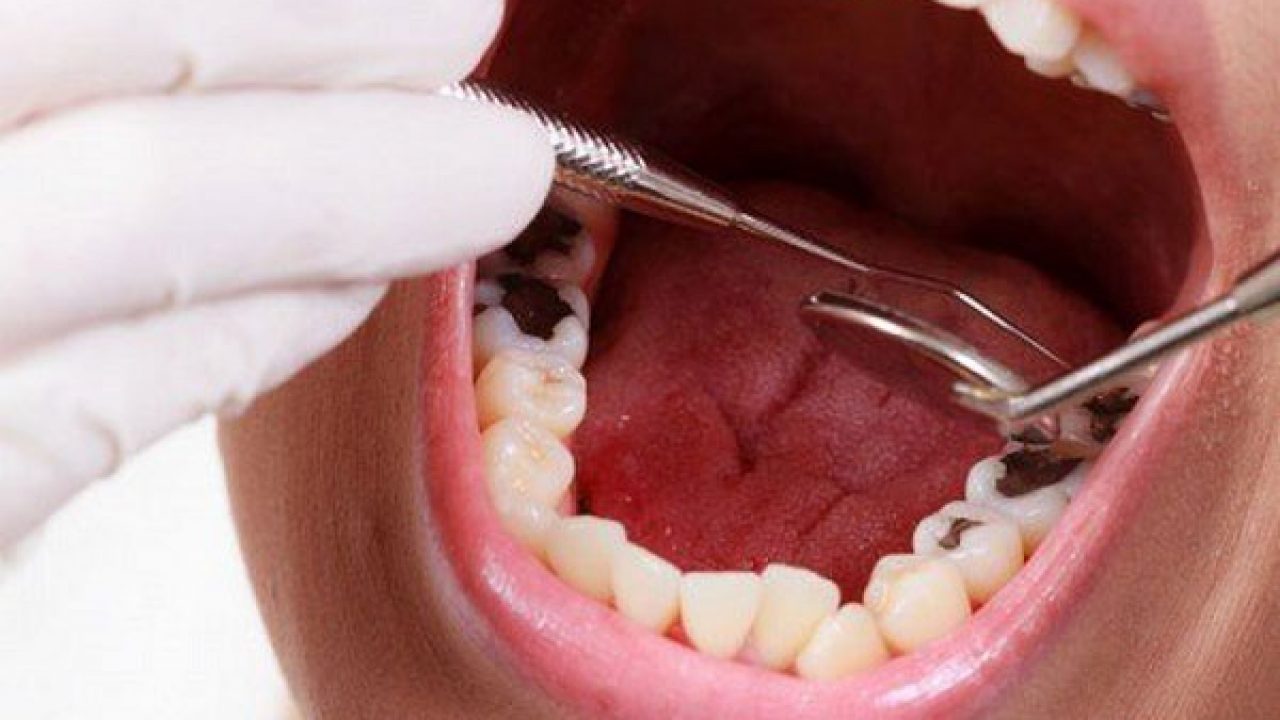 Có nên bọc răng sứ cho răng hàm bị sâu không? Chi phí là bao ...