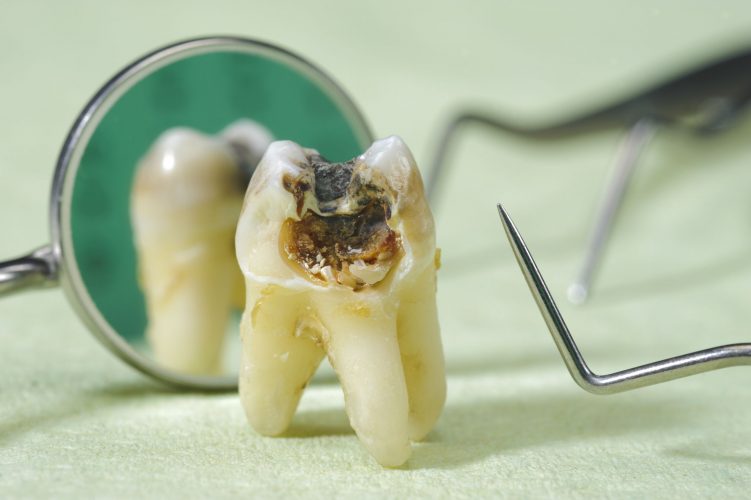 Bảng giá nhổ răng sâu ở Nha khoa Đông Nam cập nhật mới nhất là năm nào?