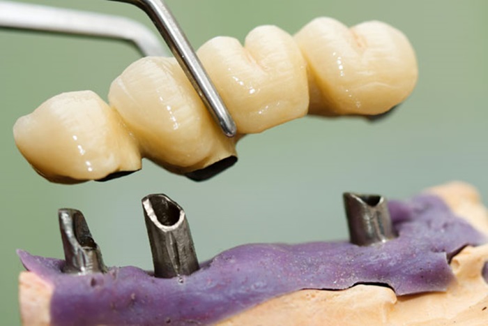 Tại sao implant bị đào thải – các yếu tố liên quan tới nha sĩ?