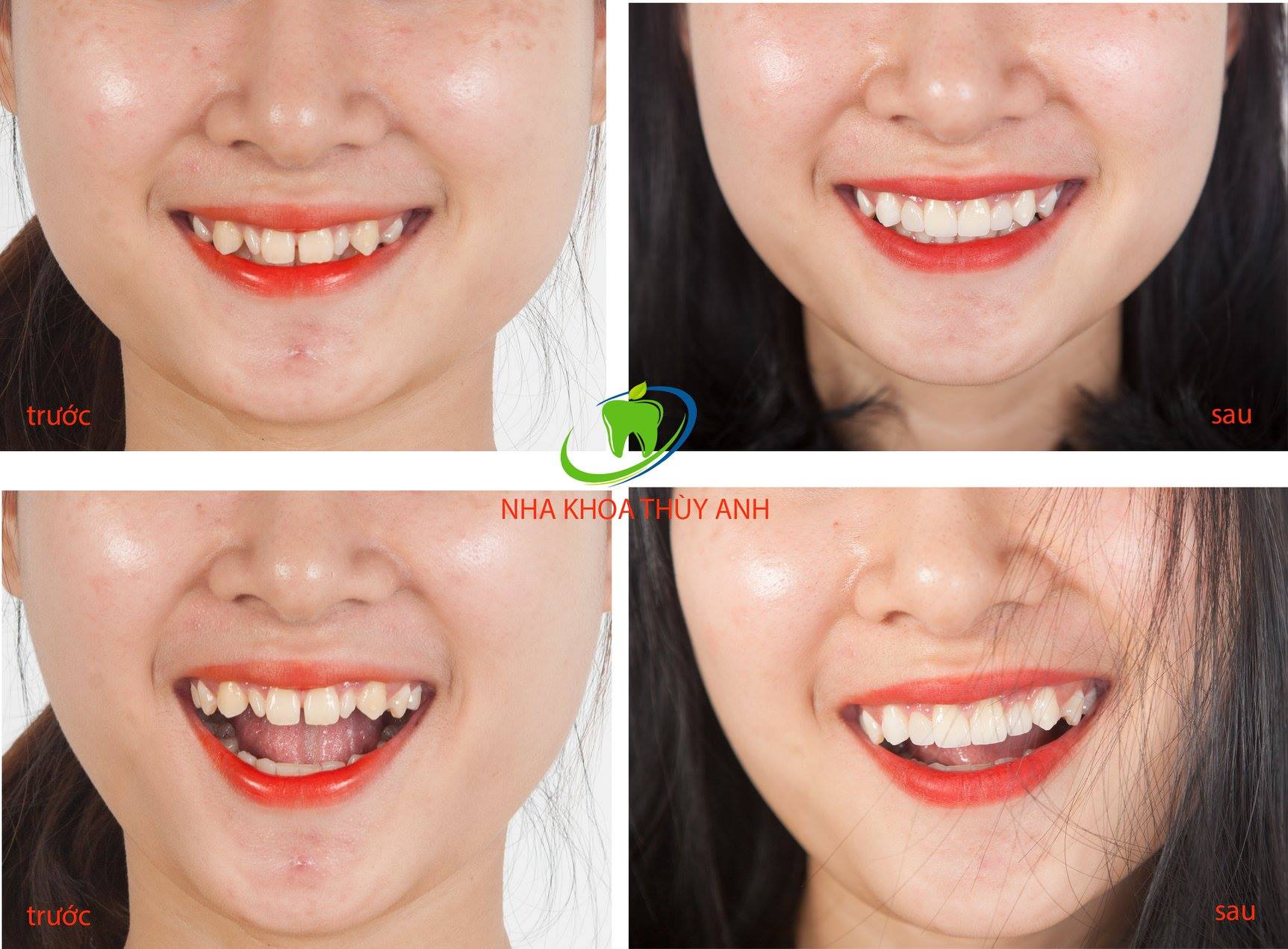 Răng Dị Dạng: “Không cần tự ti với những răng dị dạng, bạn hoàn toàn có thể sửa chữa và cải thiện vẻ ngoài của chính mình với các phương pháp làm đẹp răng miệng. Hãy xem qua hình ảnh và cùng tìm hiểu thêm về các giải pháp để có nụ cười hoàn hảo nhé!”