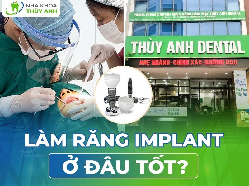 Làm răng implant ở đâu tốt tại Hà Nội?