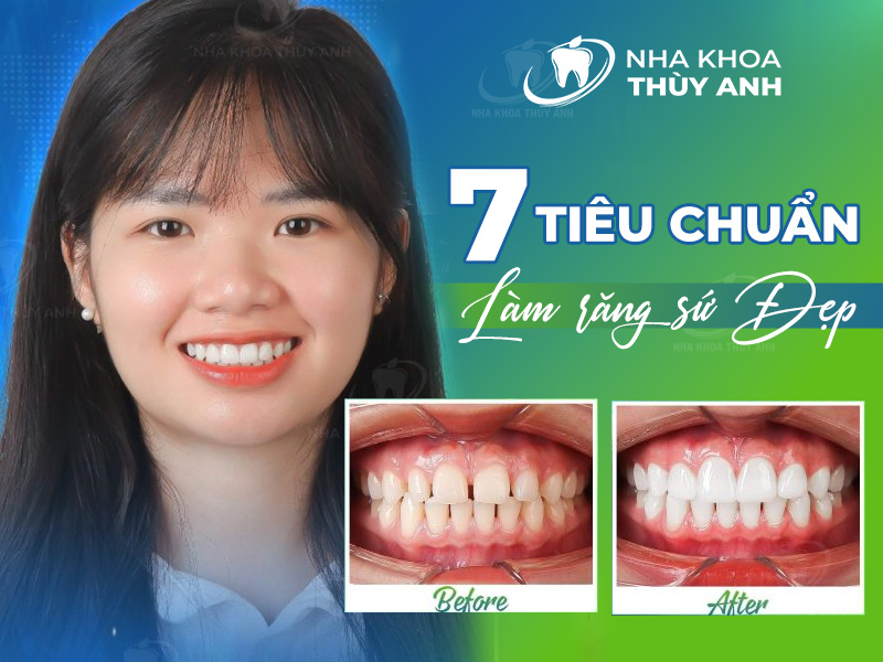 7 tiêu chuẩn làm răng sứ đẹp mang tới nụ cười tự tin, tỏa sáng