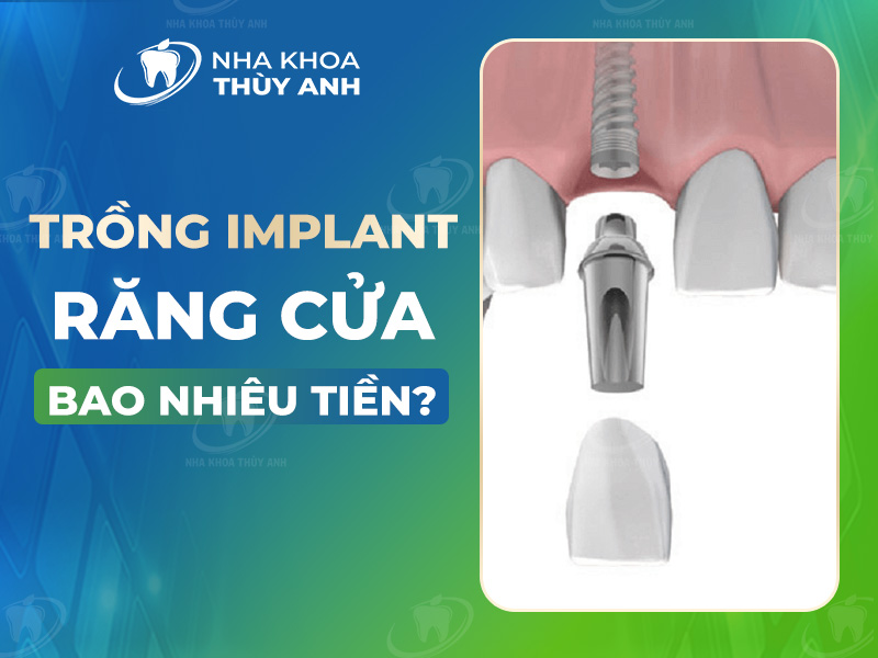 Trồng implant răng cửa bao nhiêu tiền? Quy trình thực hiện như thế nào?