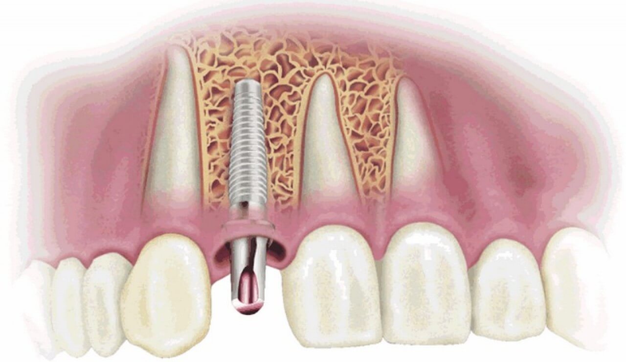 Bác sĩ chuyên khoa giải thích nguyên nhân implant bị đào thải khi cấy vào xương hàm