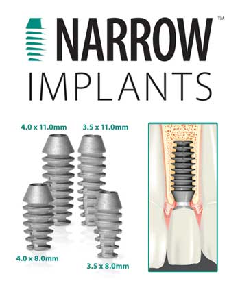 Lựa chọn implant nhỏ tránh phải ghép xương, tại sao không?