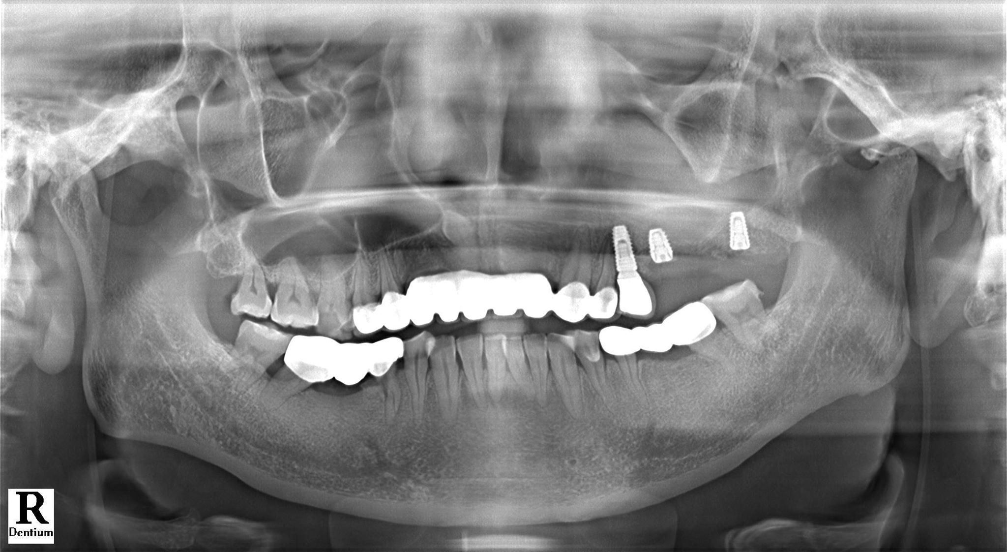 implant -nha khoa thuy anh