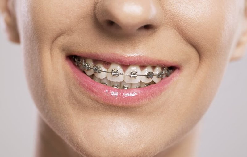 Niềng răng mắc cài kim loại có điểm gì khác biệt so với niềng răng mắc cài  sứ? - nhakhoathuyanh