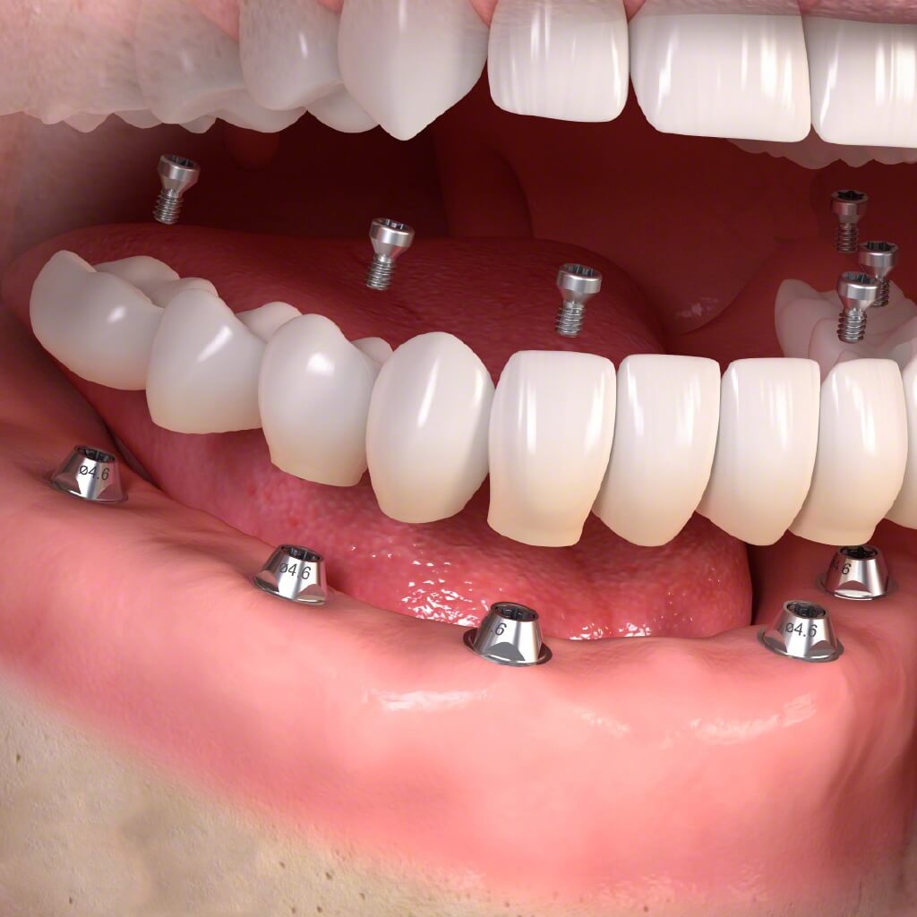 Trồng răng implant toàn bộ hàm 