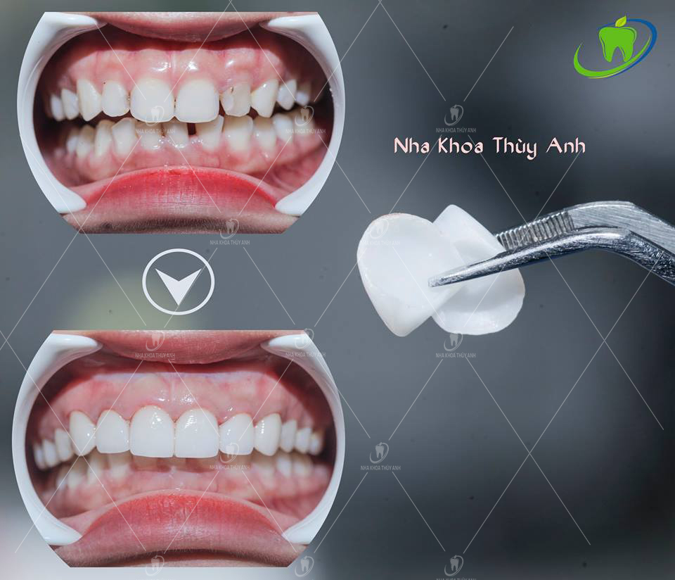 Sâu kẽ răng cửa, biểu hiện và chi phí điều trị - nhakhoathuyanh