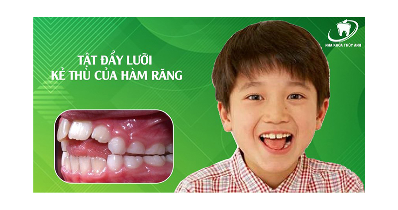 Tật đẩy lưỡi – và các bài tập lưỡi hiệu quả trong niềng răng