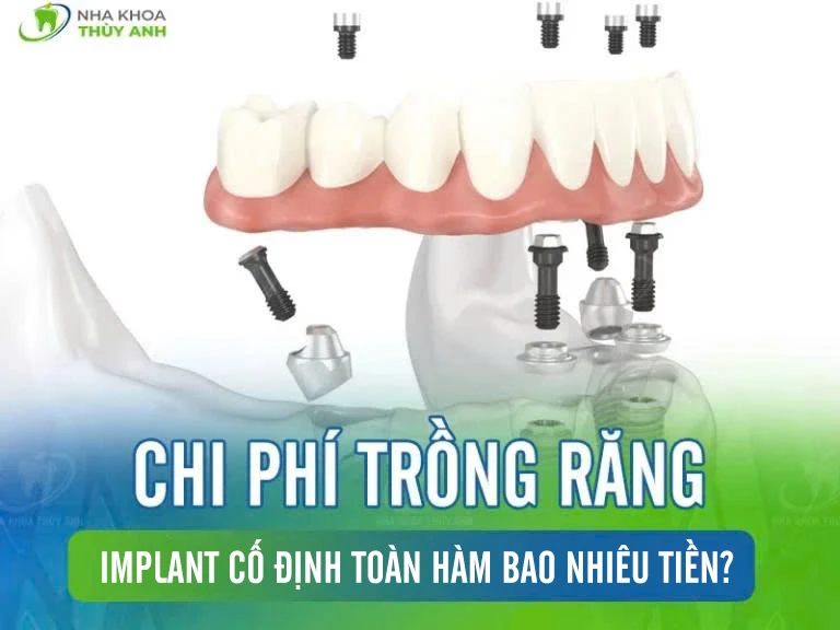 Chi phí trồng răng implant cố định toàn hàm bao nhiêu tiền?