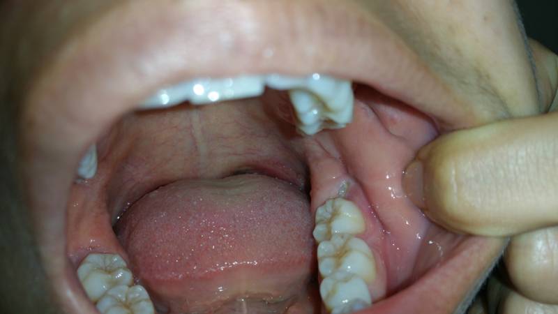 Nhổ răng bị sót chân: Nguyên nhân, dấu hiệu nhận biết và cách xử ...