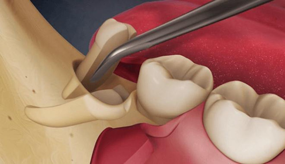 What are the potential complications of having an open wound after removing wisdom teeth stitches?