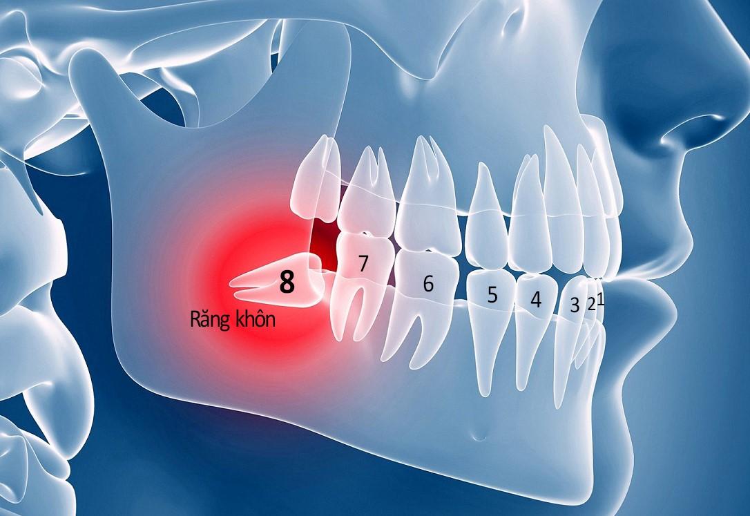 Thuốc tê nào thường được sử dụng trong quá trình nhổ răng khôn?
