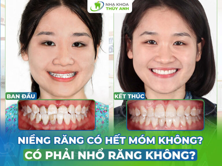 nieng rang co het mom khong