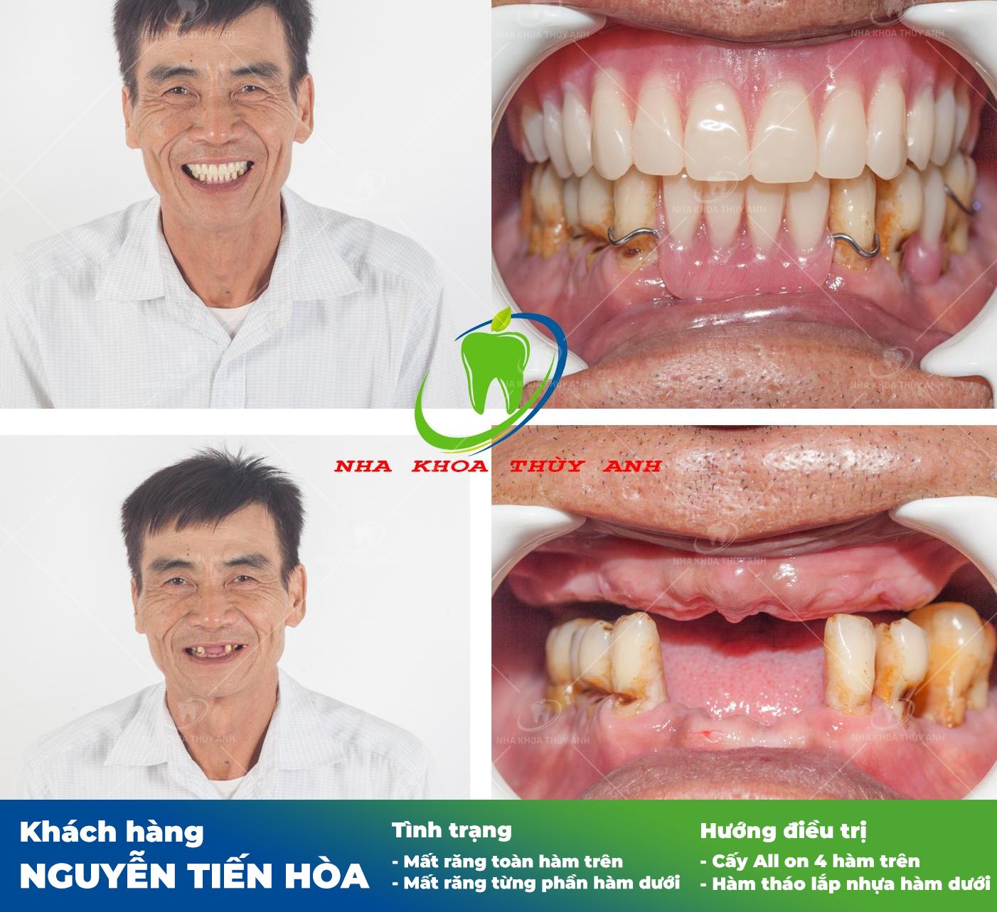 Trồng răng implant cho người già có được hay không?