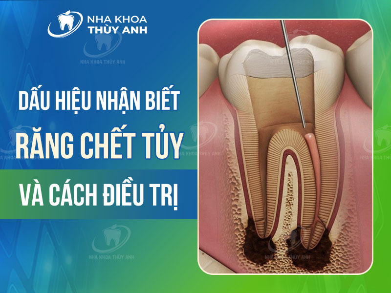Răng bị chết tủy: Dấu hiệu nhận biết và cách điều trị hiệu quả