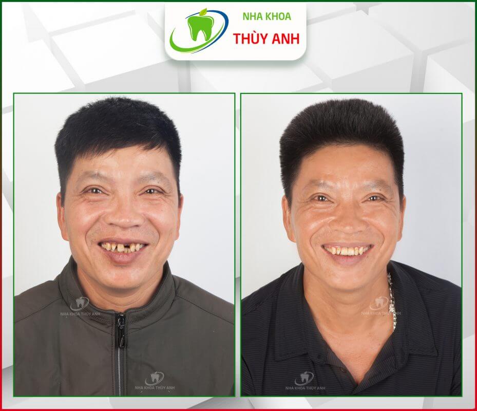 “Trồng implant răng cửa không hề đau như chú nghĩ” – Chia sẻ của chú Nông Văn Mới – 48 tuổi