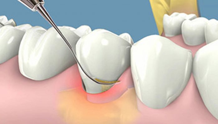 Việc lấy cao răng có ảnh hưởng tới mô mềm không?
