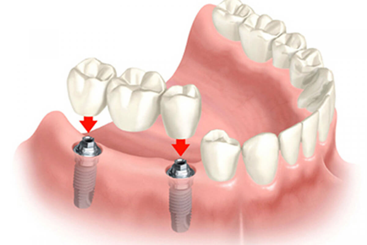 Mất nhiều răng thì cấy ghép implant có tốt không? Nha khoa Thùy Anh