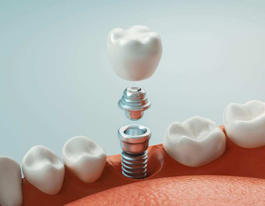 Phục hình răng sứ trên implant là gì? Quy trình thực hiện ra sao? -  nhakhoathuyanh
