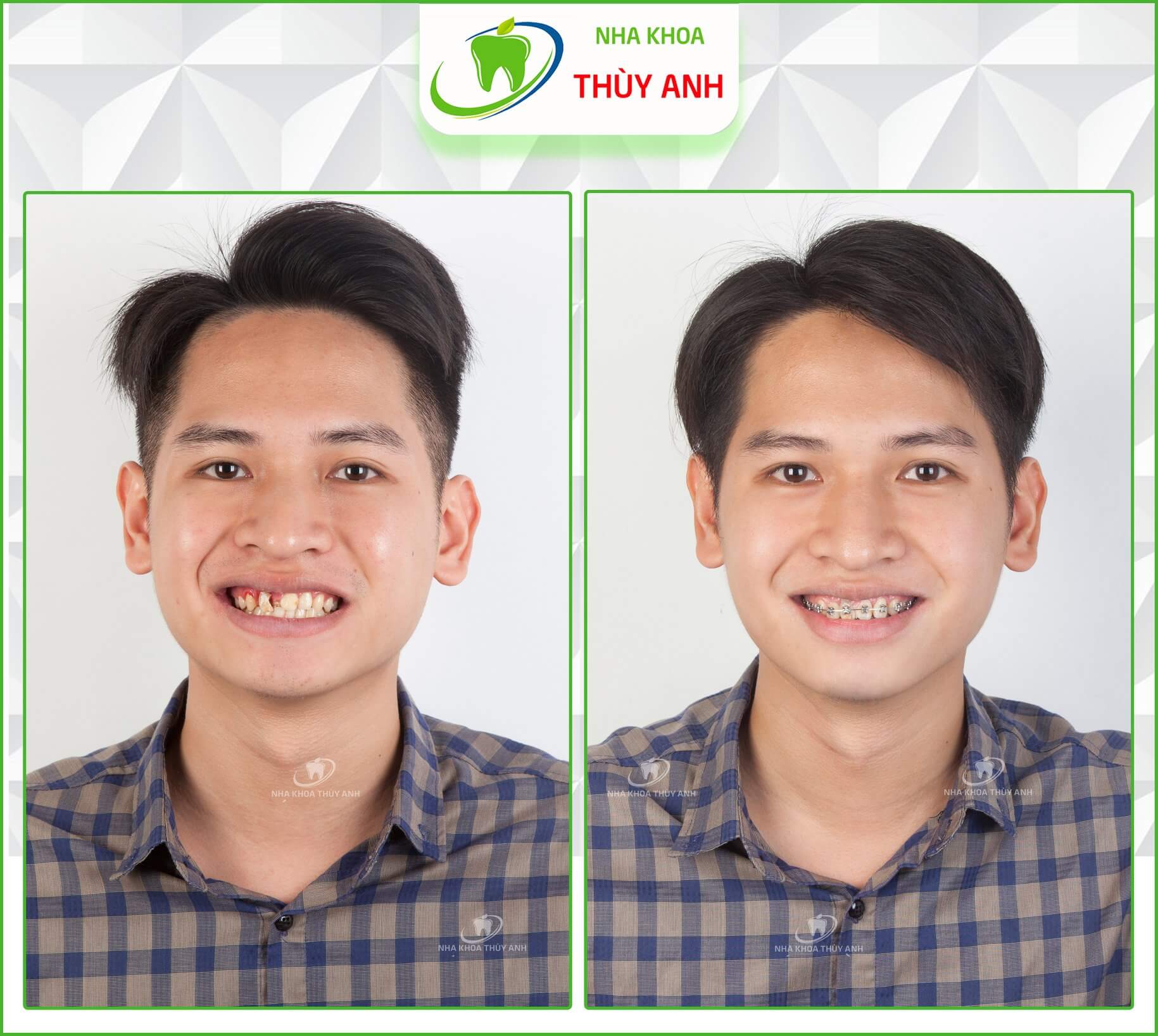 Tại sao niềng răng mắc cài kim loại vẫn được chưa chuộng nhất?