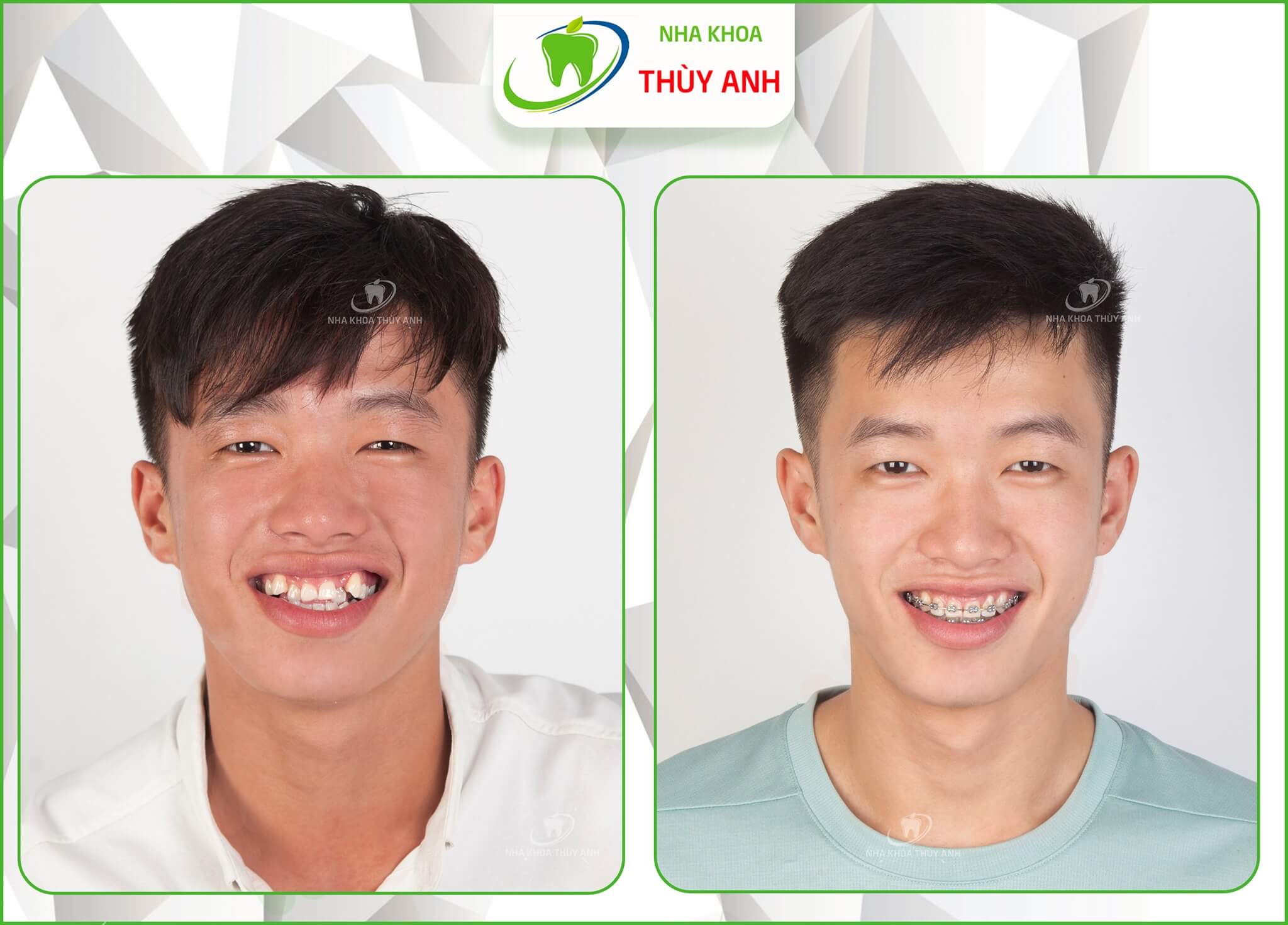 Trường hợp nên và không nên niềng răng mắc cài kim loại – nha khoa Thùy Anh