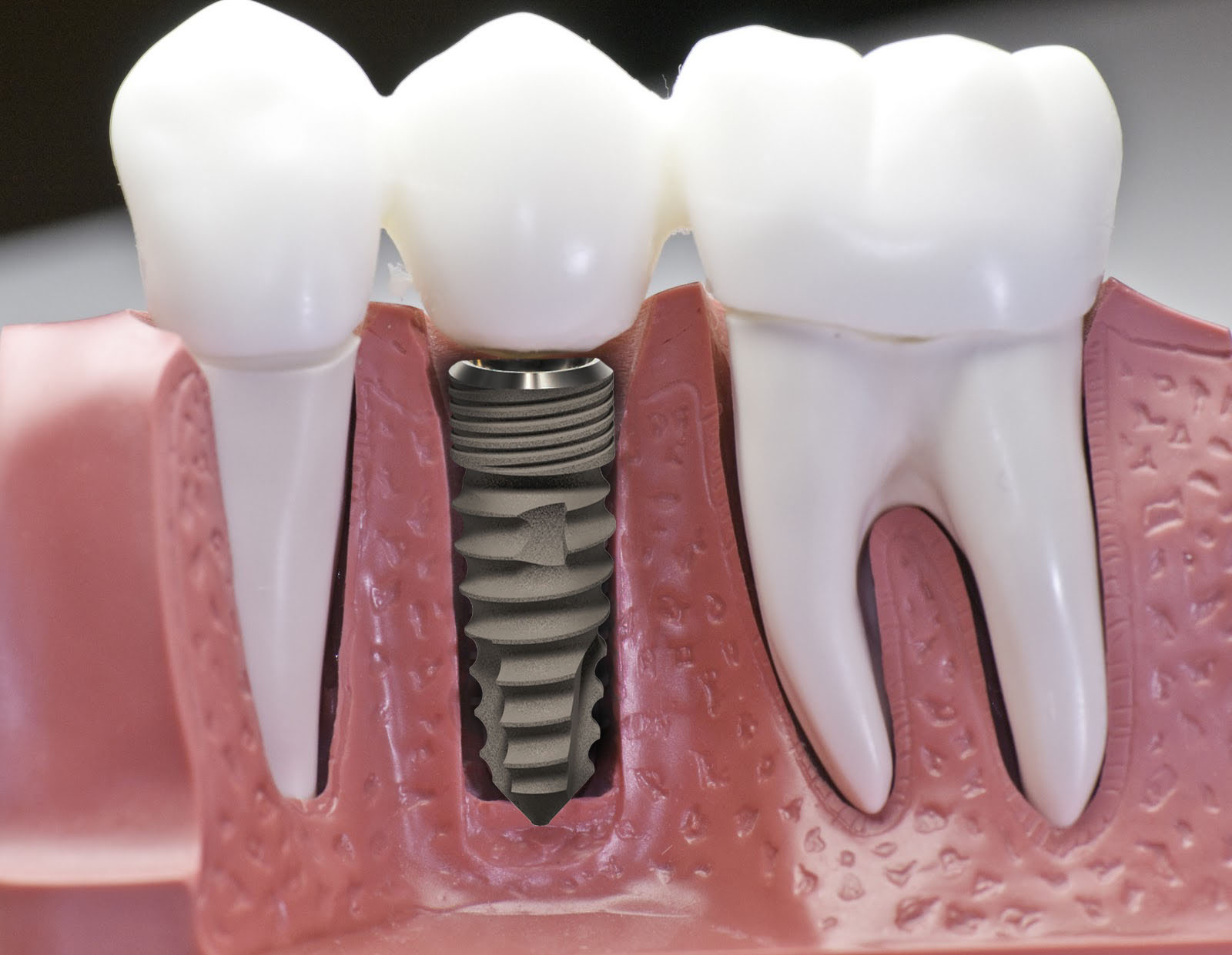 Răng implant bị lung lay: Nguyên nhân và cách khắc phục hiệu quả