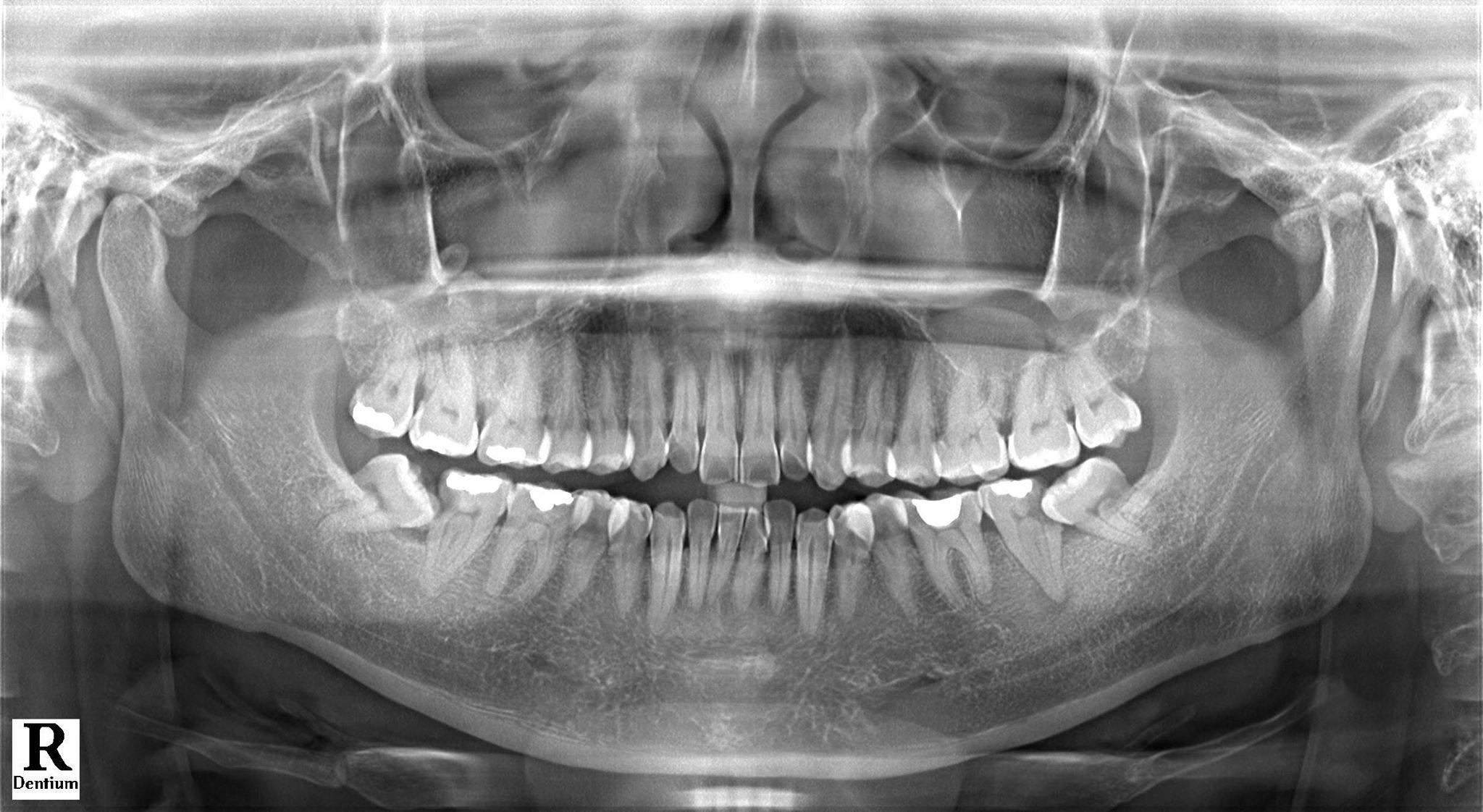 Tại sao nên chụp X-quang răng khôn? Nha khoa Thùy Anh