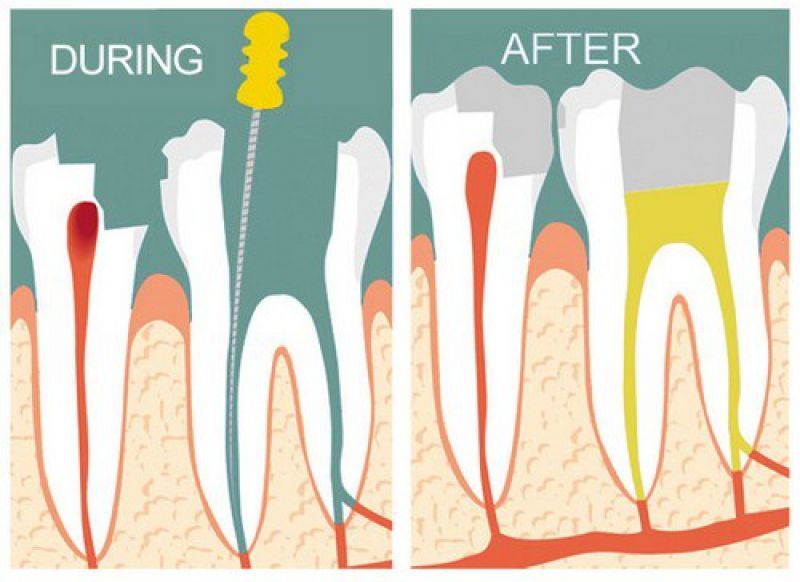 Làm thế nào để biết điều trị tủy răng đã thành công? Yếu tố đánh giá chất lượng bác sĩ